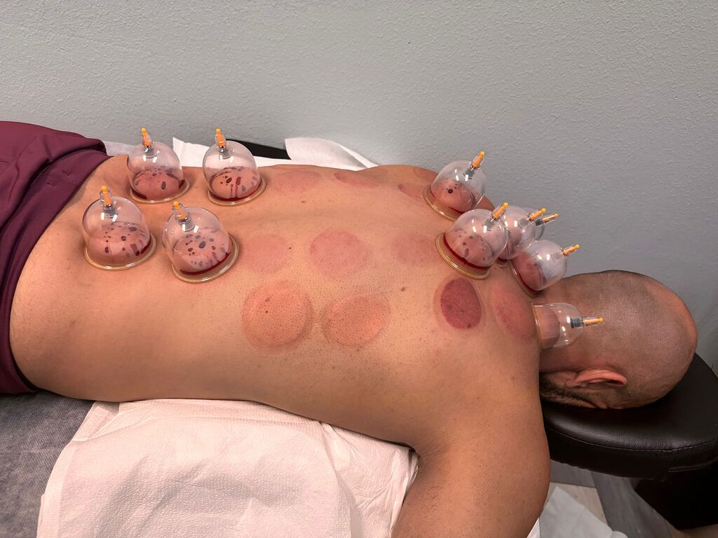 Hijama Session